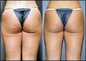 lipoliza