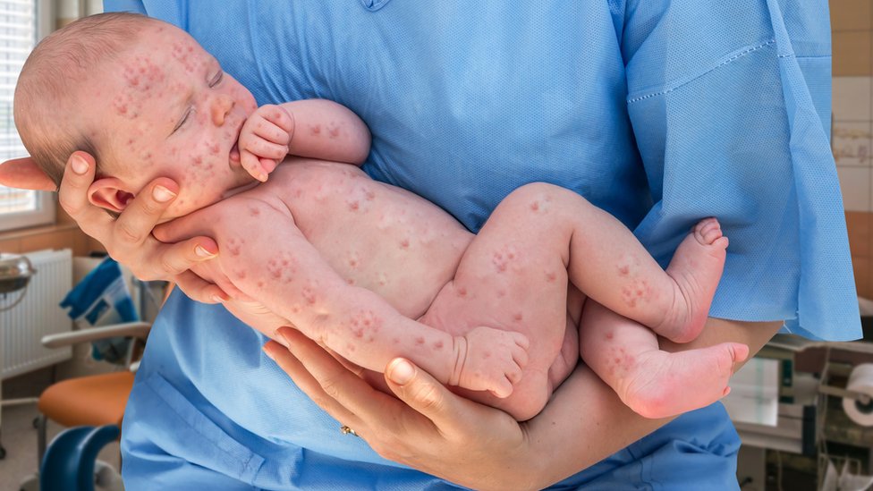 Vakcine, zdravlje i Srbija: Novi Pravilnik o obaveznoj i preporučenoj vakcinaciji - 2 Baby with measles