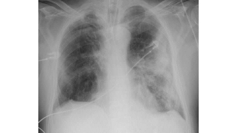 Korona virus: Anatomija pandemije respiratorne bolesti Kovid-19 23 Snimak pluća 68-godišnjaka sa teškim oblikom Kovid-19. Beline na plućima su džepovi zahvaćeni upalom, zbog čega pacijent ima poteškoće sa disanjem
