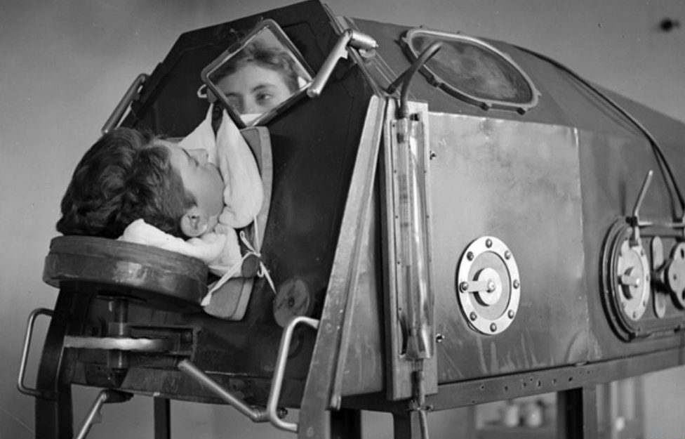 A boy lying inside an iron lung