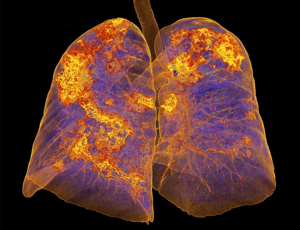 Korona virus, srce i pluća: Koje su dugoročne posledice Kovida-19 i koliko traju - pet pitanja i odgovora 3 Lungs infected with coronavirus