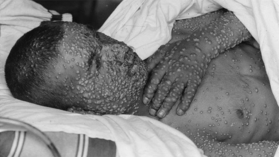 A smallpox patient covered with pustules