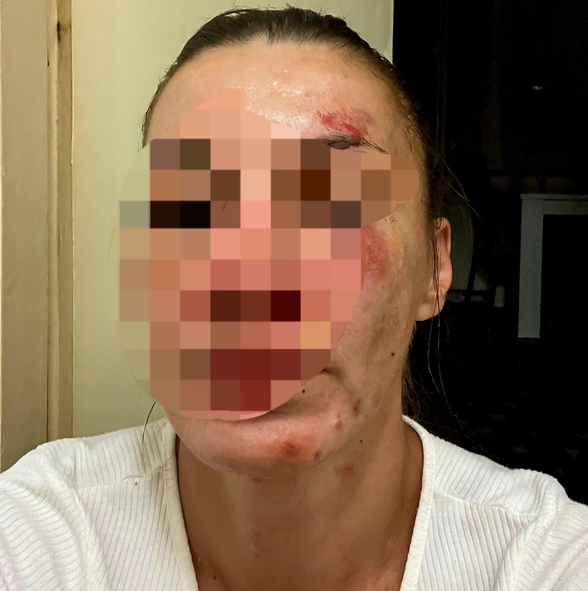 Siledžije: Stevanić u društvu SNS funkcionera koji je brutalno pretukao partnerku (FOTO, VIDEO) 2 pretucena devojka sabac 1 1